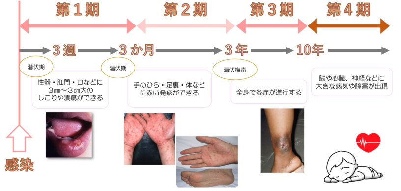 感染の機会から3週間程度でしこりや潰瘍ができ、3か月程度で全身に発疹が広がります。放置すると脳や心臓、神経などに重大な障害を及ぼす可能性があります。症状が軽快、なくなっても治ったわけではないため、注意が必要です。