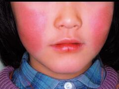 両側の頬に出現した蝶翼状の発しん