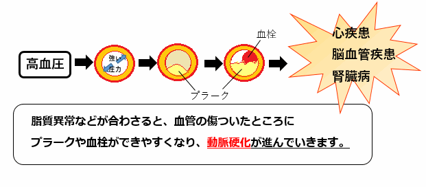 高血圧に脂質異常などが合わさると動脈硬化が進むリスクが高まることを説明した図